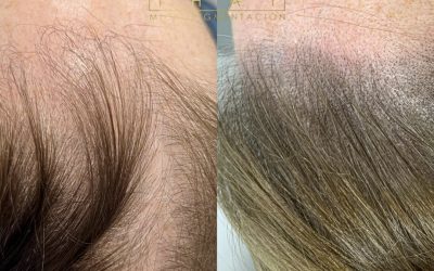 ¿Sufres de poca densidad de cabello en la zona capilar?