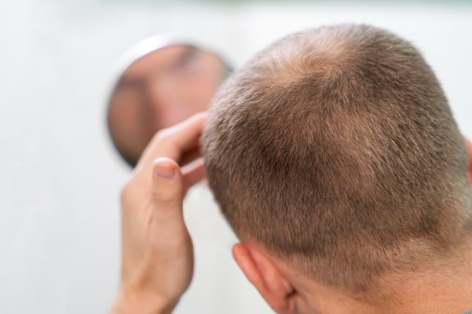 La Alopecia en España: Un Problema de Salud Pública que Afecta a más del 42% de la Población