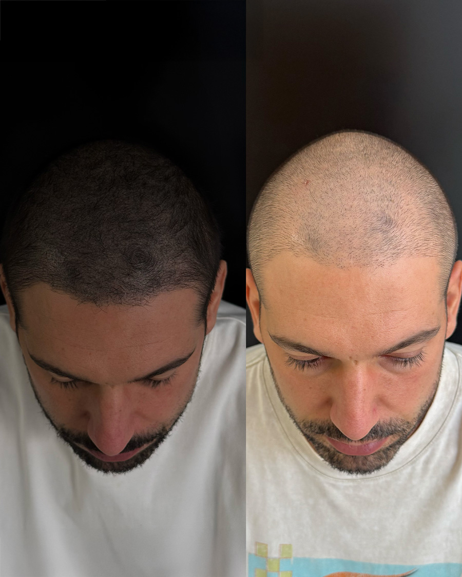 micropigmentacionbcapilar valencia