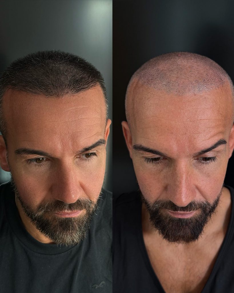 micropigmentacionbcapilar valencia