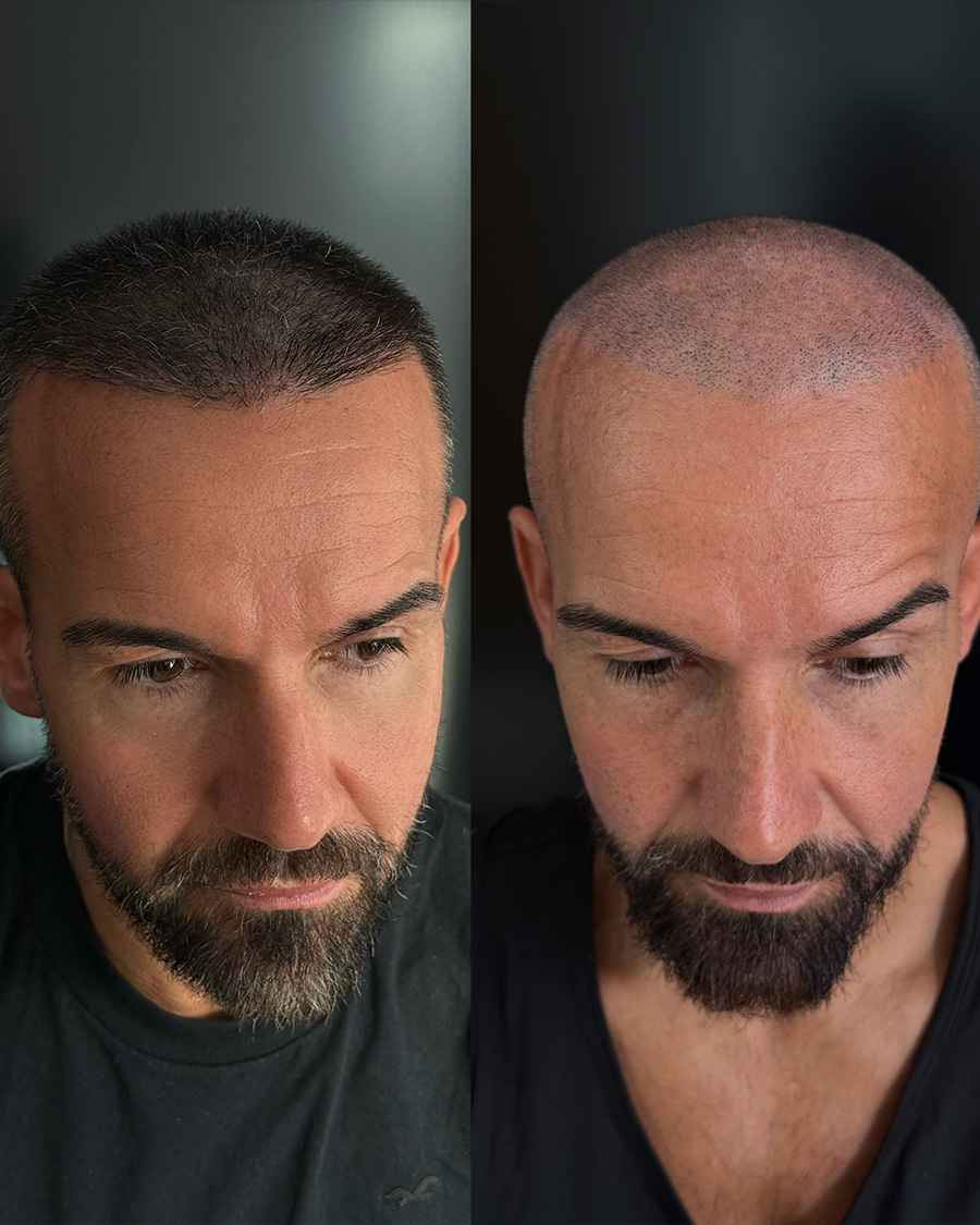 micropigmentacionbcapilar valencia