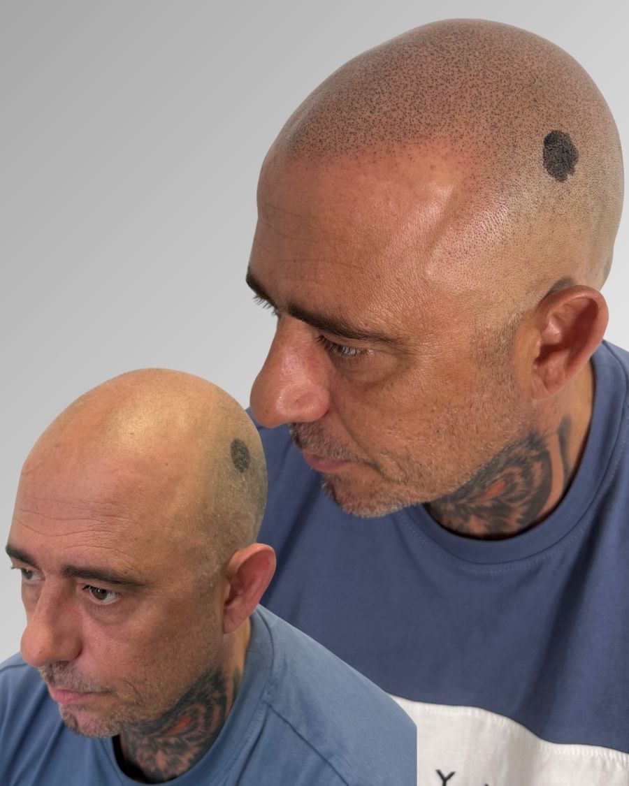 Antes y después tratamiento microcapilar