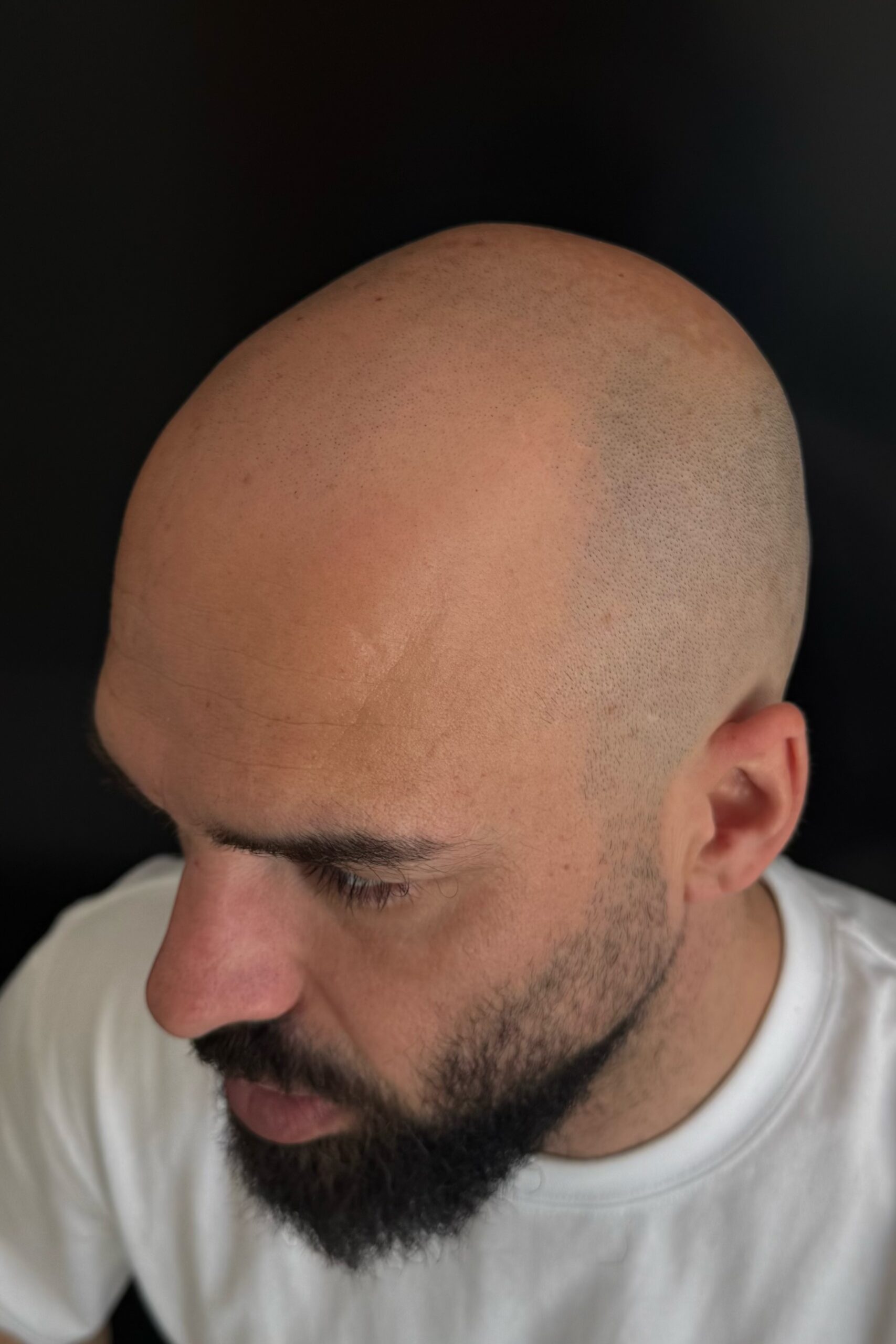 Antes del tratamiento microcapilar