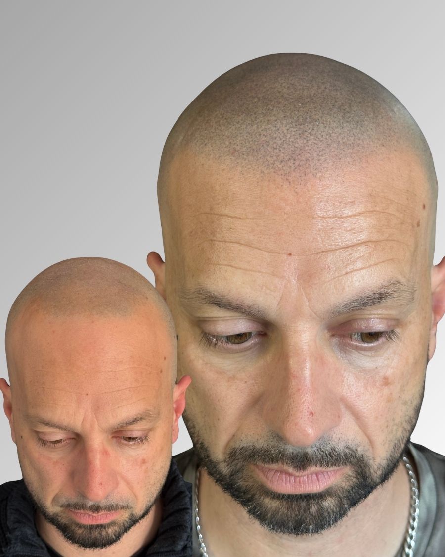 Antes y después de micropigmentación capilar