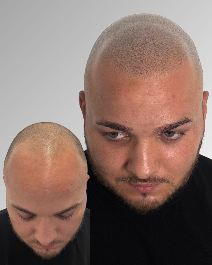 Antes y después micropigmentación capilar