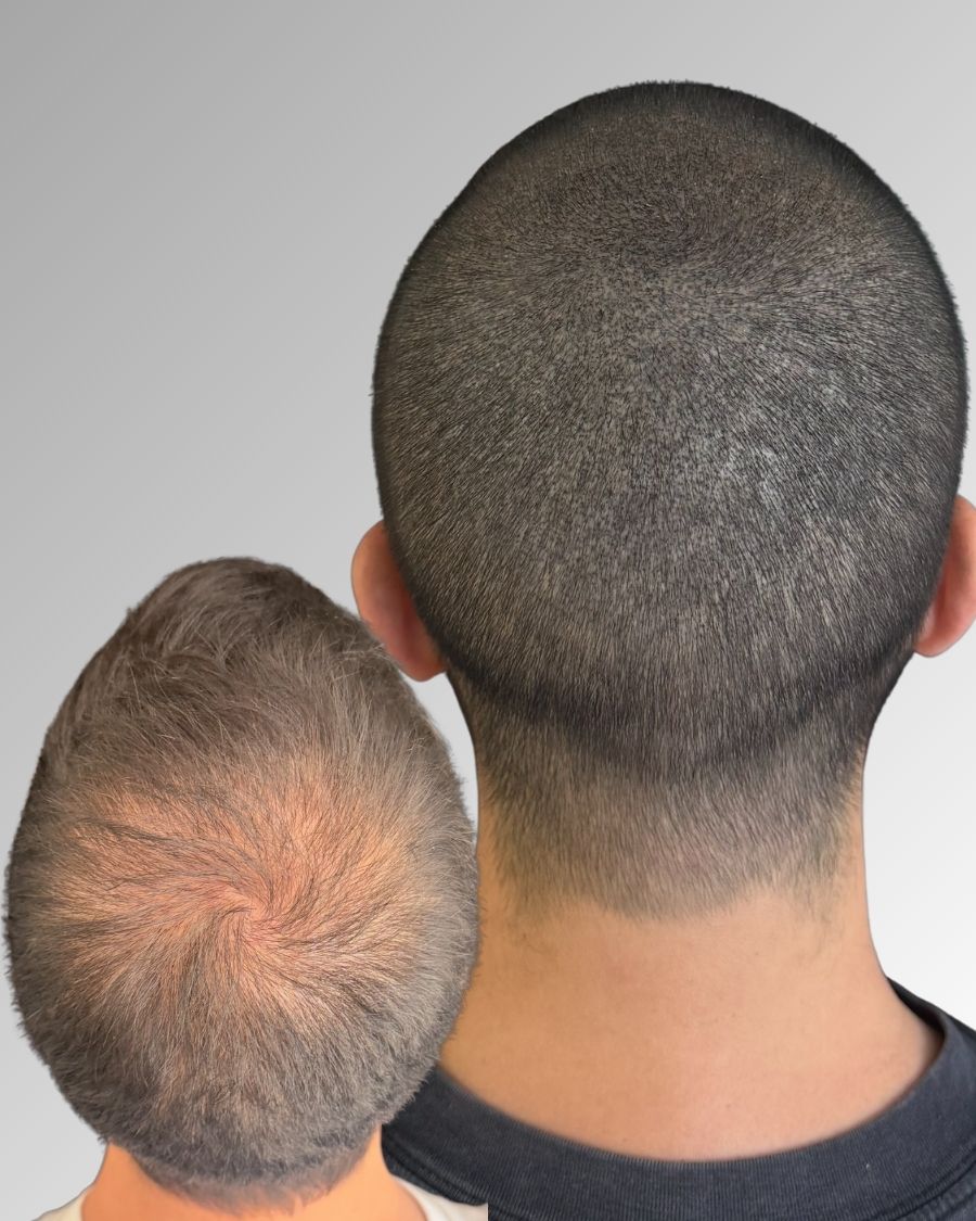 Antes y después micropigmentación capilar efecto densidad