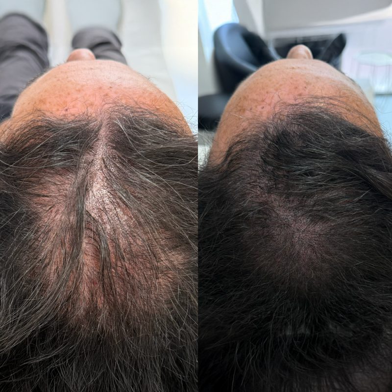 efecto-densidad-micropigmentacion-capilar